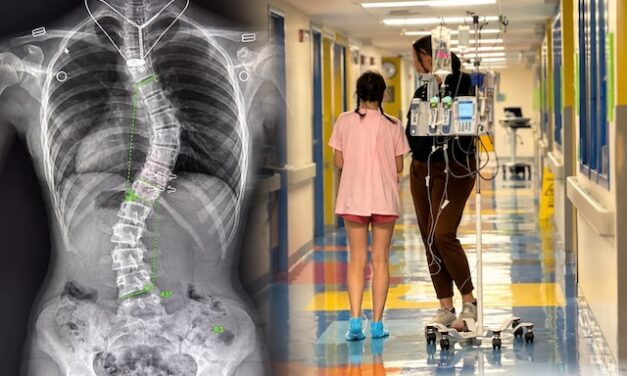 Bearden dancer stands taller after scoliosis surgery